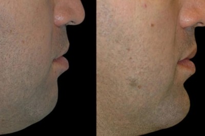 Chin Fillers Treatments in Dubai: The Role of Chin Fillers