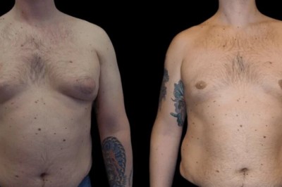 Best Doctors in Dubai for Gynecomastia Surgery Success