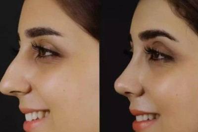 Post-Operative Care Tips from the Best Septoplasty Surgeons in Dubai