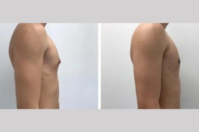 Best Gynecomastia Surgeon in dubai for lasting male confidence