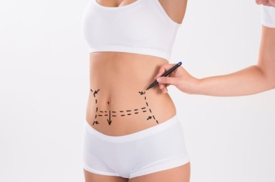 Common Myths vs. Facts About Liposuction in Dubai