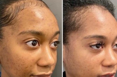 What to Expect After a Chemical Peel: Healing Tips from the Best Doctors in Dubai