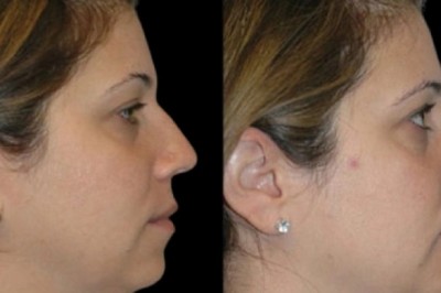 Factors that affect the cost of double chin removal in Dubai