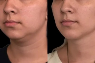 Are results from Double chin removal surgery in Dubai natural-looking?