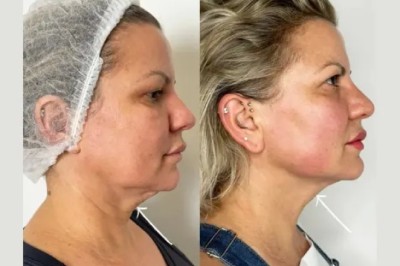 The Best Plastic Surgeons in Dubai Reveal How Endolift Helps Reverse Early Signs of Aging