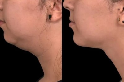 Kybella for Double Chin Removal: Advice from the Best Doctors in Dubai