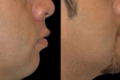 Comparing liposuction to Double chin removal surgery in Dubai