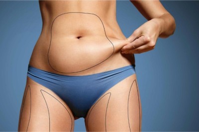 Benefits of Abdominoplasty in Dubai