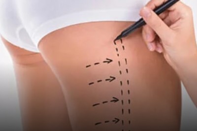 Patient Stories of Thigh Liposuction in Dubai