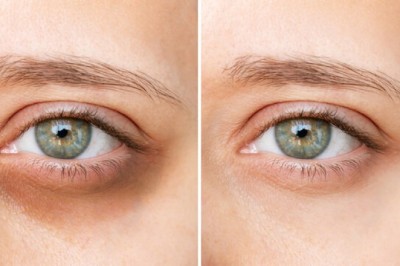 أسرار علاج الهالات السوداء وإشراقة جديدة للبشرة