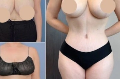 Everything to Expect After Your Tummy Tuck in Dubai