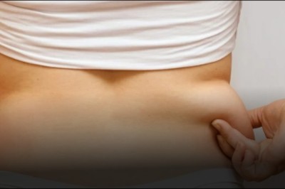 What to Expect from Back Liposuction in Dubai