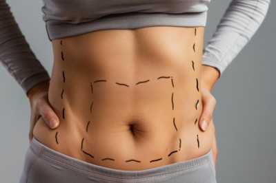 Liposuction in Dubai for Thighs, Arms, and Abdomen