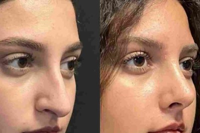 Rhinoplasty in Dubai for Refined and Natural Appearance