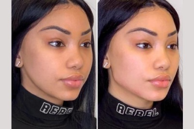 Best Doctors in Dubai for Thread Lift Enhanced Beauty