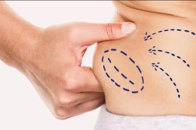 Surgical Journey Explained by Best Liposuction Surgeon in Dubai