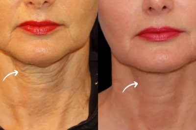 Sculptra Technology Driven Results by Best Plastic Surgeon in Dubai