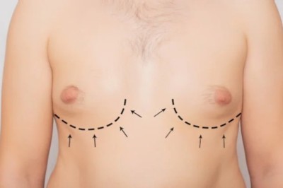 Gynecomastia in Dubai Medical Excellence You Can Trust
