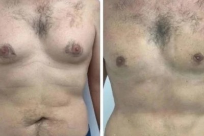 Why Dubai Has the Best Gynecomastia Surgeon in Dubai