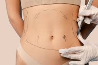 Why Consultation with the Best Liposuction Surgeons in Dubai Is Important