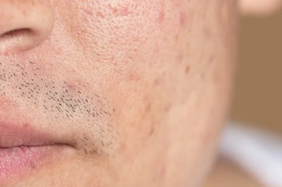 What Steps Affect Large Pores Treatment Cost in Dubai)