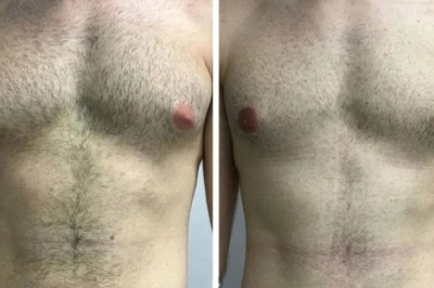 The Role of Healthy Lifestyle Choices in Preventing Gynecomastia in Dubai