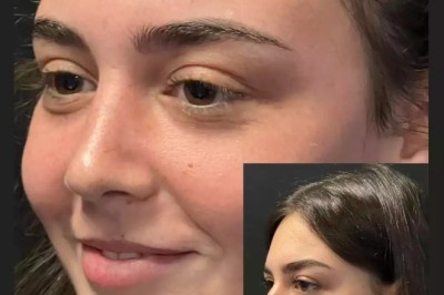 What Techniques Does the Best Rhinoplasty Surgeon in Dubai Use?