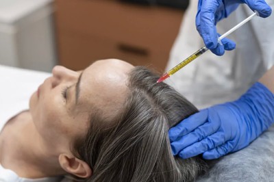 Why Is Best PRP Hair Treatment in Dubai in High Demand)