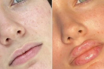 Fillers Treatments in Dubai: What Makes Them Effective