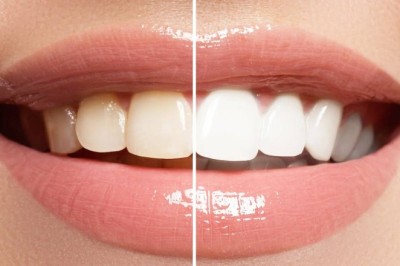 Teeth Whitening Cost in Dubai: Complete Price Guide