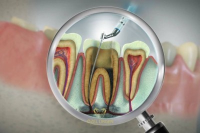 Affordable Root Canal Treatment in Dubai Clinics