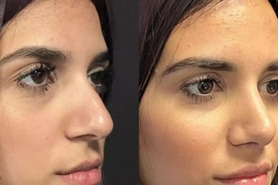 Best Doctors in Dubai Offering Septoplasty Insights