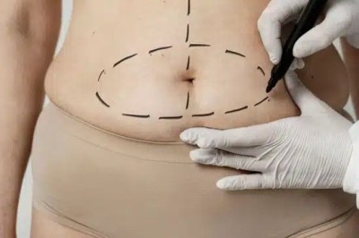 Tummy Tuck in Dubai Recovery Timeline: What to Expect Day by Day