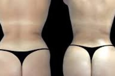 Butt Fat transfer in Dubai for fuller and rounder shape