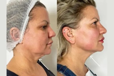 Best Aesthetic Clinics in dubai using Endolift for jawline contouring