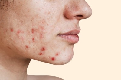 When Acne Treatment in Dubai Delivers Results?