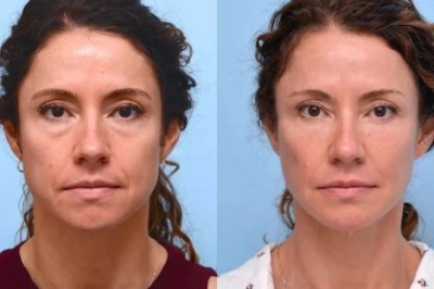 Best Doctors in Dubai Offering Customized Thread Lift Solutions for Facial Lifting