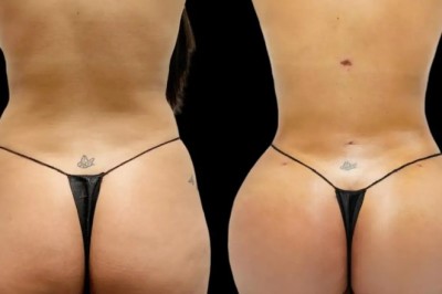 Fat Transfer Surgery in Dubai for Personalized Cosmetic Treatments