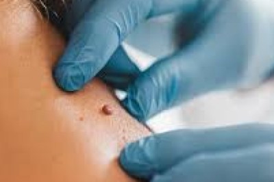 Moles Removal in Dubai: Modern Cosmetic Removal Techniques Explained