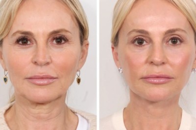 Best Plastic Surgeon in Dubai Specializing Professional Thread Lift