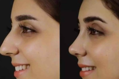 Best Septoplasty Surgeons in Dubai for Chronic Nasal Blockage