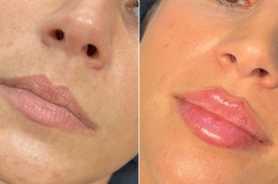 Juvederm Treatments in Dubai for Early Signs of Aging
