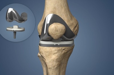 Restore Active Living with Total Knee Replacement Surgery in Faridabad