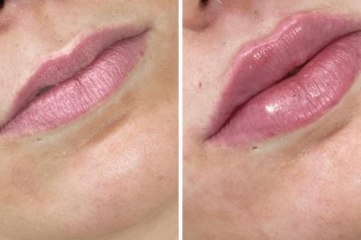 Juvederm for Jawline Contouring by the Best Plastic Surgeons in Dubai