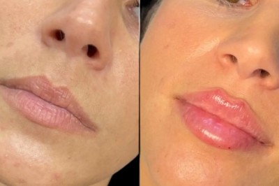Confidence Begins with the Best Plastic Surgeon in Dubai for Fillers