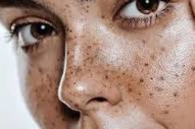 Pigmentation Treatment In Dubai: Even Skin Tone