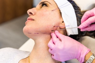 Thread Lift in London: A Non-Surgical Solution for Facial Sagging