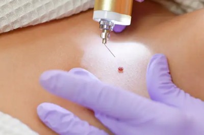 Laser Wart Removal in Dubai: Clinical Approach and Patient Care