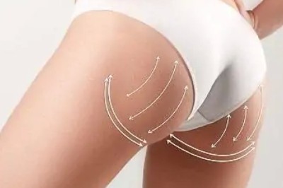 Transform Your Figure with BBL Dubai & Abu Dhabi | Glamorous Clinic in Dubai