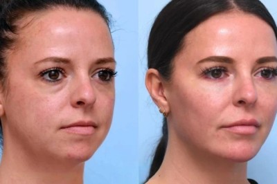 Best Doctors in Dubai with Advanced Thread Lift Techniques